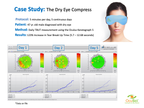 Case study of a dry eye compress with patient data and OculSci logo.